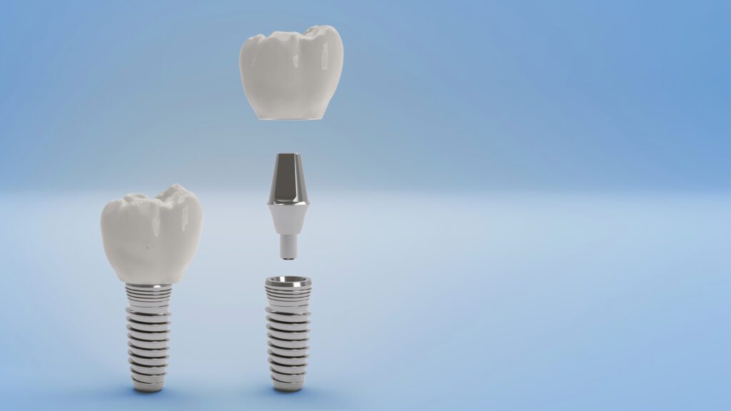 Dental Implants in Port Charlotte, FL