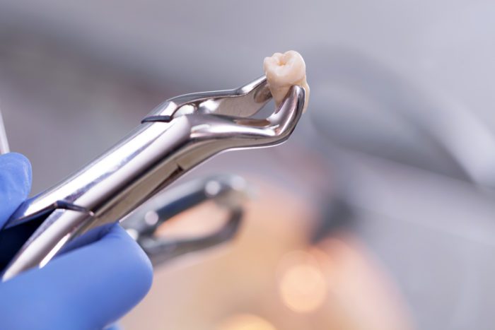 Tooth Extraction in Port Charlotte, FL